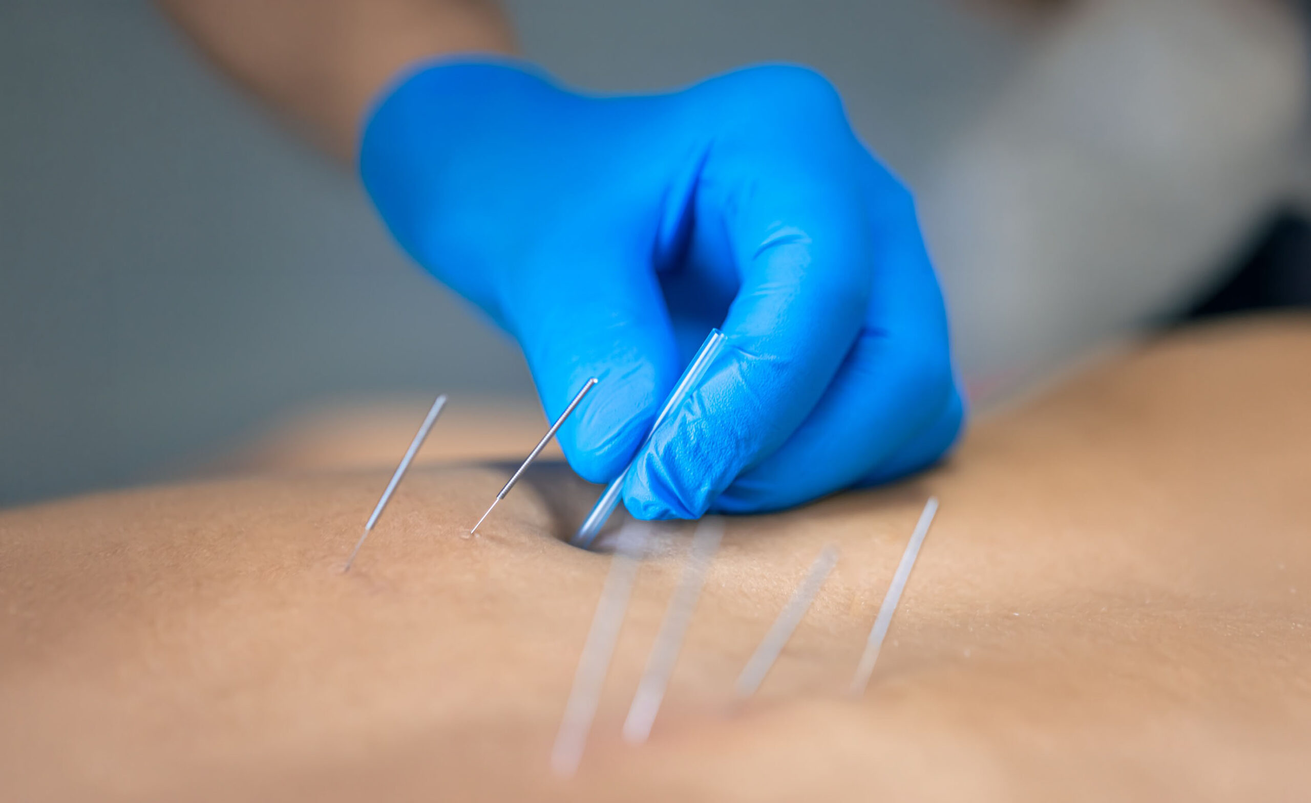 Vorbereitung einer medizinischen Akupunkturbehandlung in einer orthopädischen Praxis in Berlin